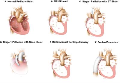 Frontiers Current State Of The Art In Hypoplastic Left Heart Syndrome